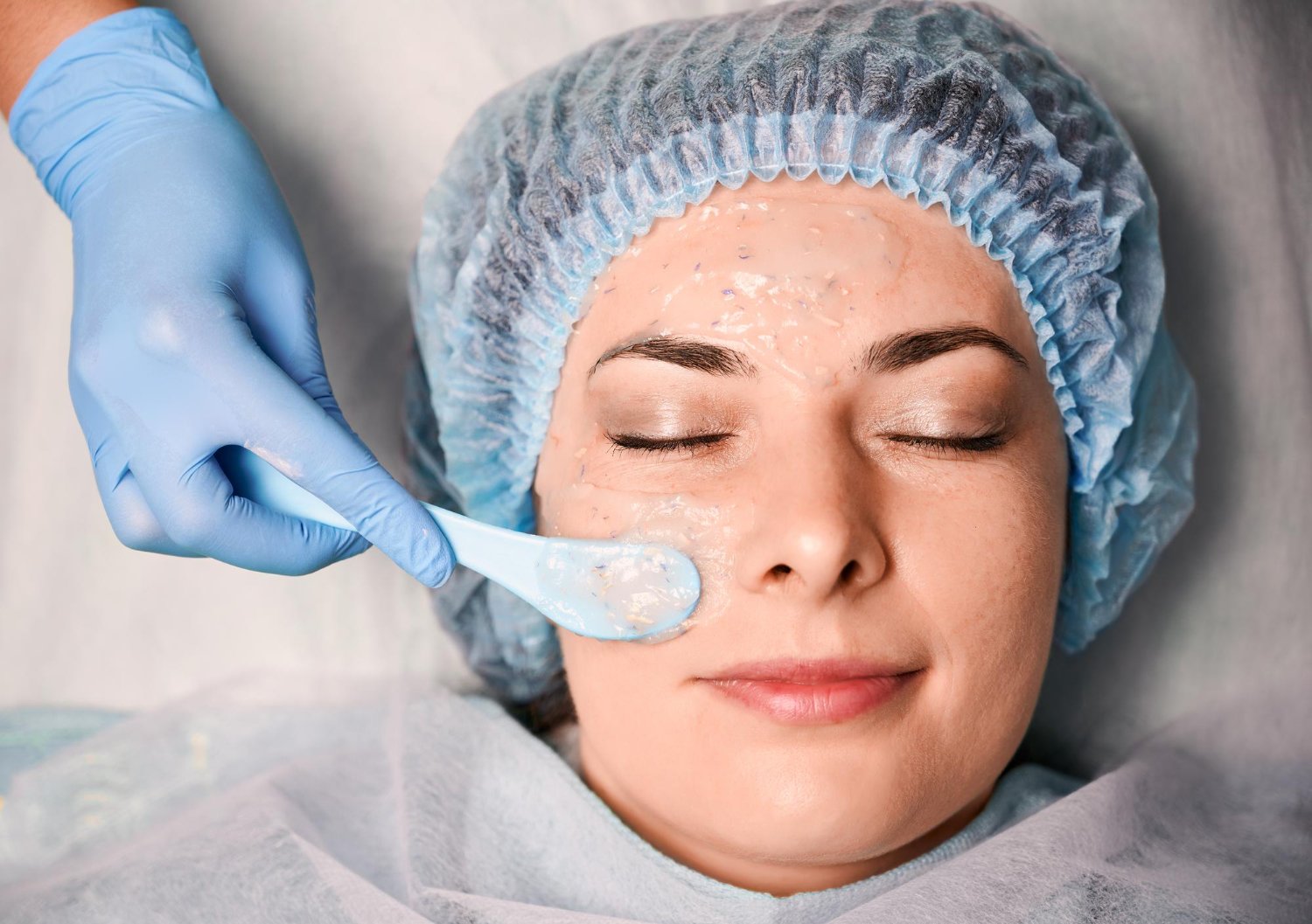 Χημικό peeling για ακμή: Η σύγχρονη δερματολογική λύση για καθαρό δέρμα
